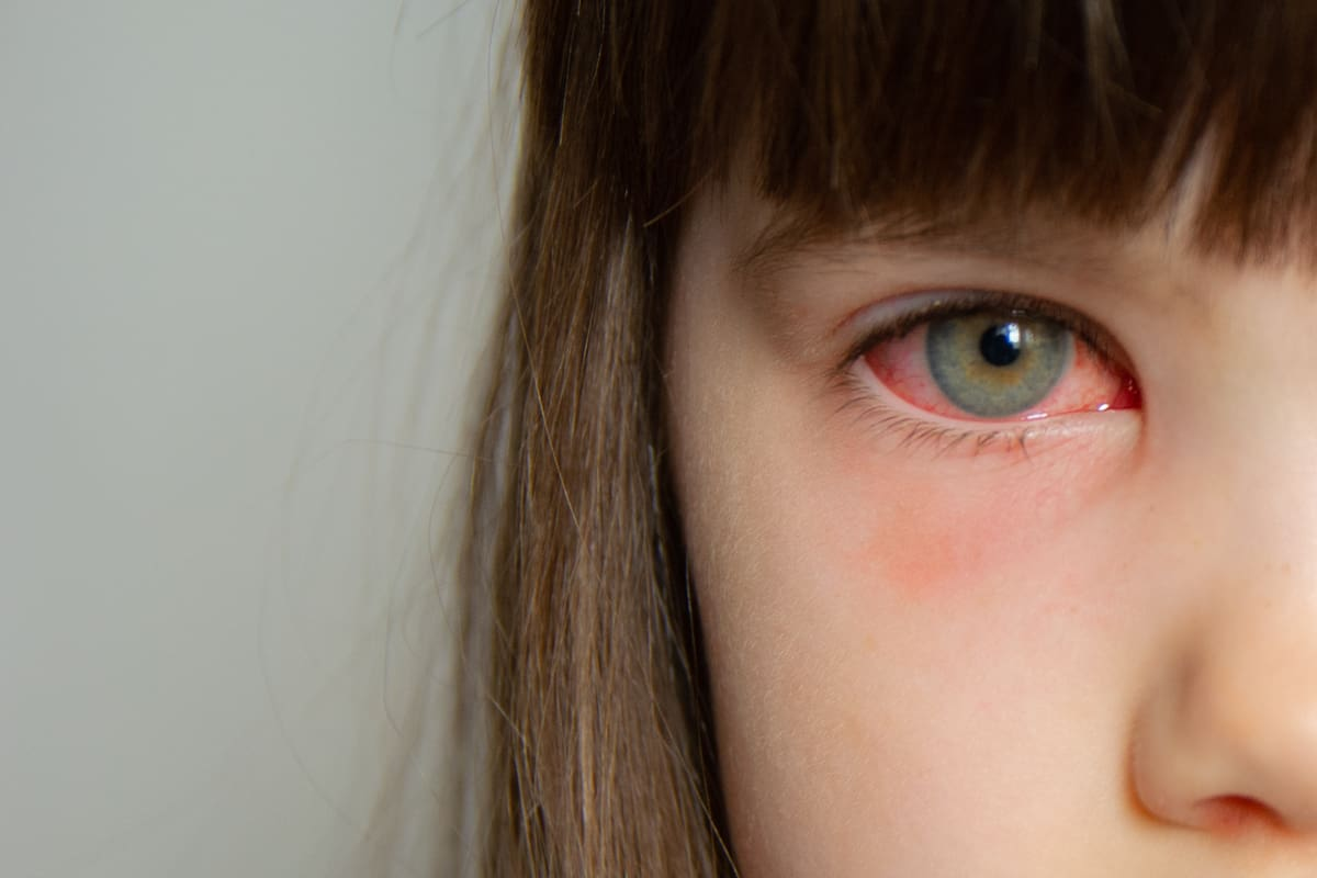 Pink Eye vs Allergic Reaction: Key Signs 2 Pink Eye vs Allergic Reaction: Key Signs