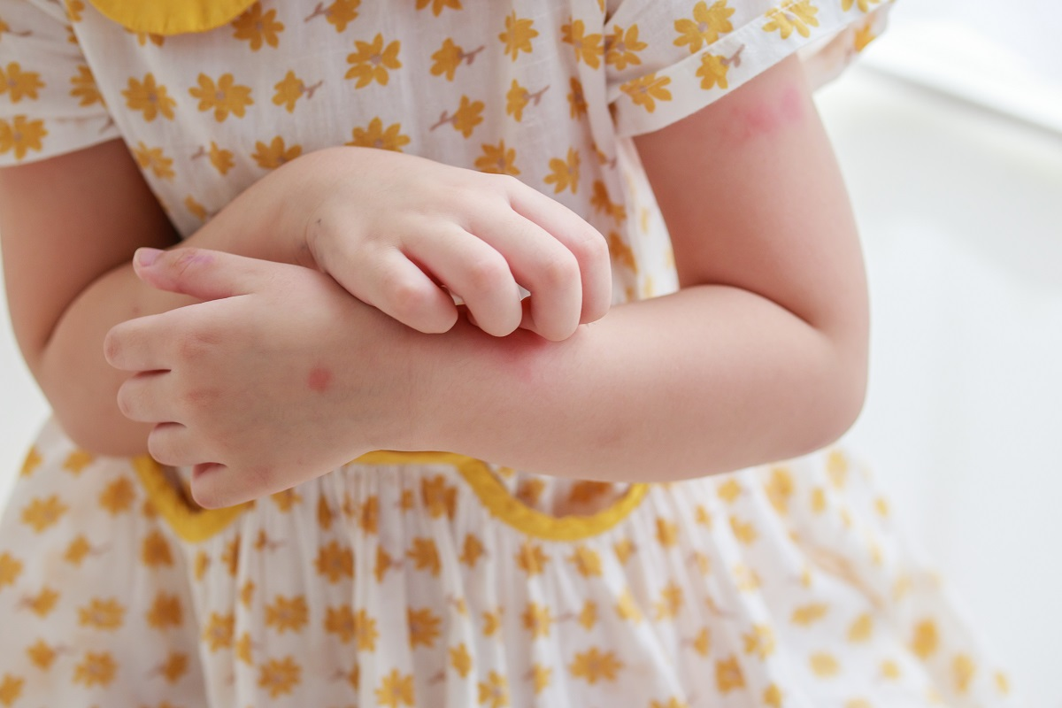 Physical Urticaria Hives: Best Treatment
