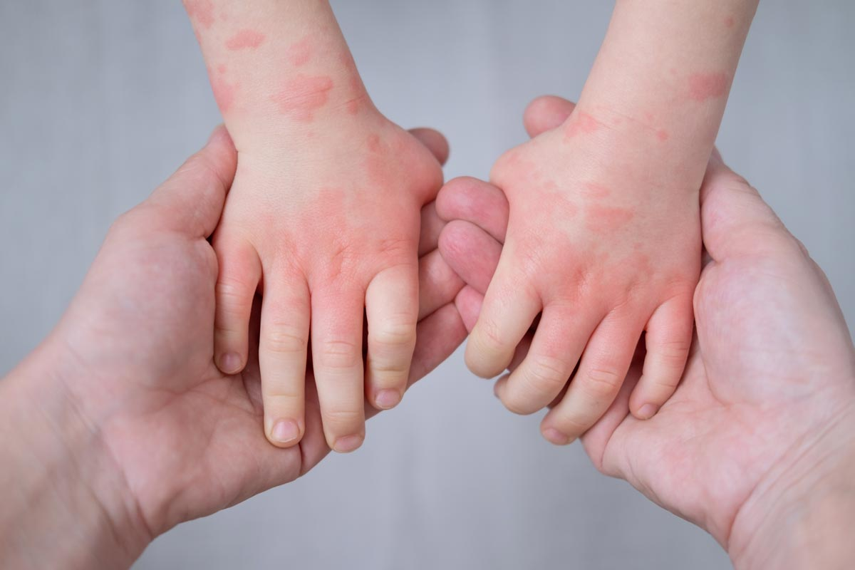 Baby Allergic Reaction Rash: Signs & Care