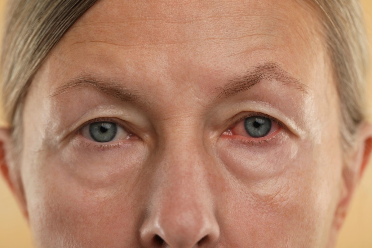 Allergic Conjunctivitis or Pink Eye?
