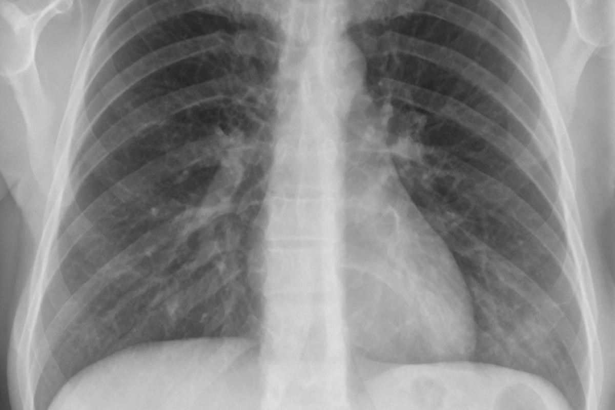 Can a Cold Turn Into Pneumonia?
