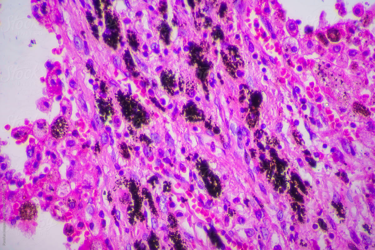 Signs of Viral Pneumonia to Look For