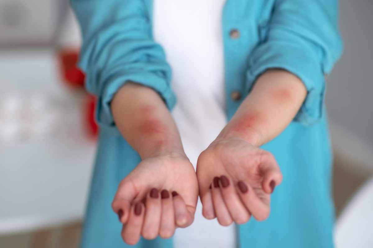 Can Hives Be a Sign of Something Serious?