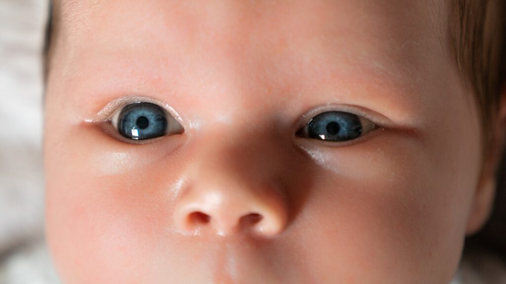 Surgery for Congenital Ptosis 1 surgery for congenital ptosis