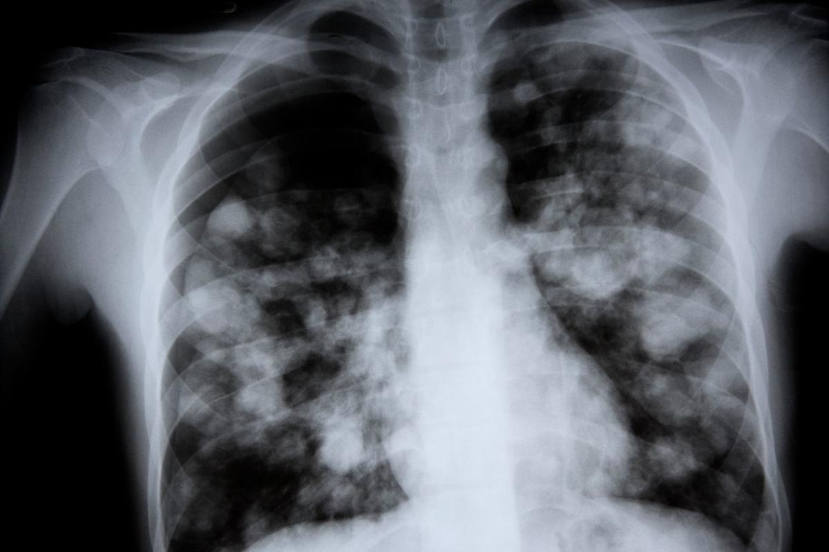 Can You Catch Pneumonia? Vital Safety Facts