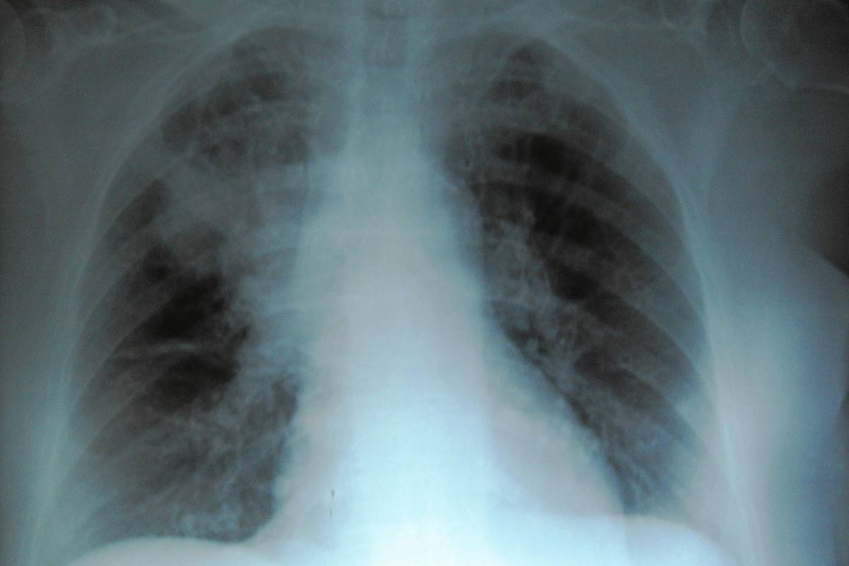 Can Pneumonia Go Away on Its Own?