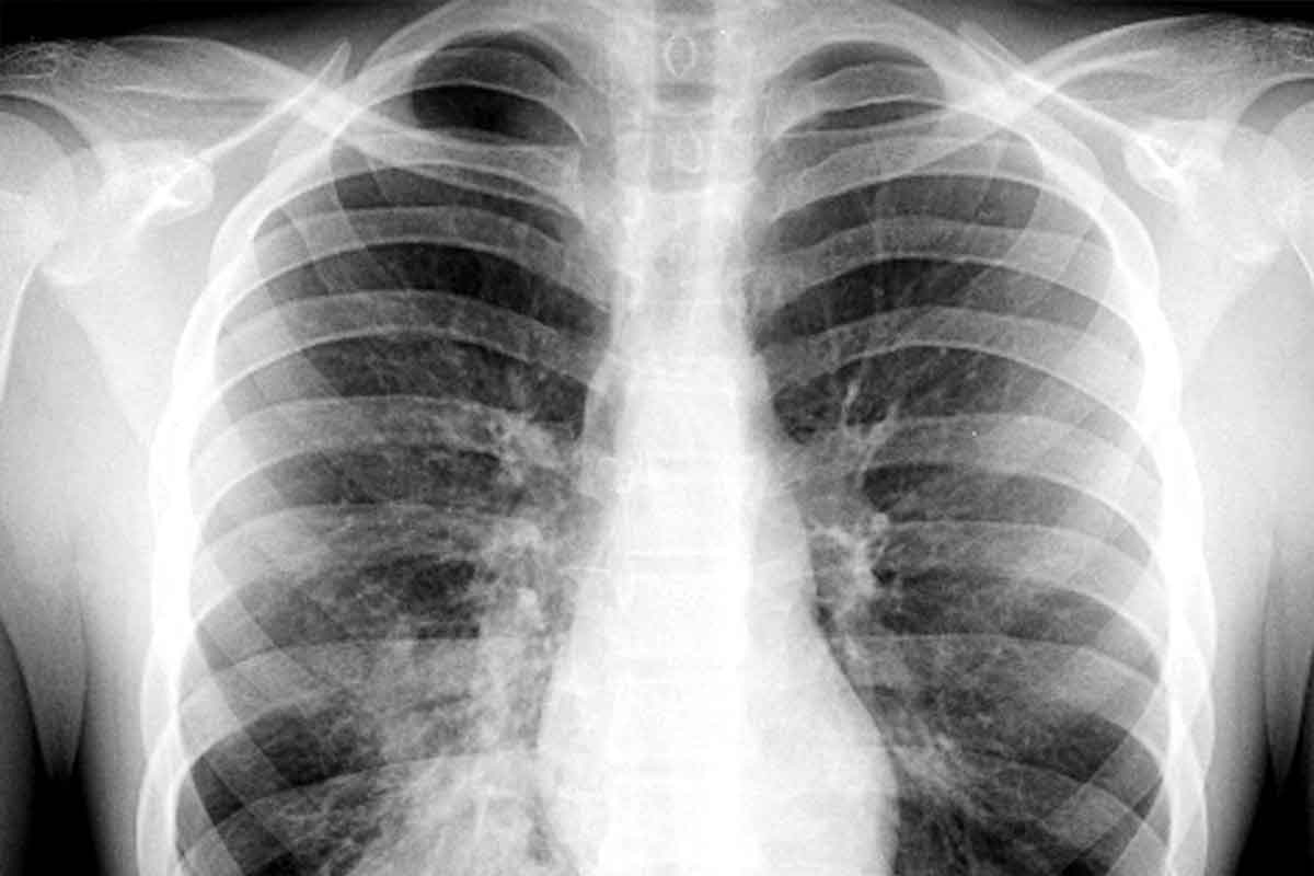 Can You Catch Pneumonia? Vital Safety Facts