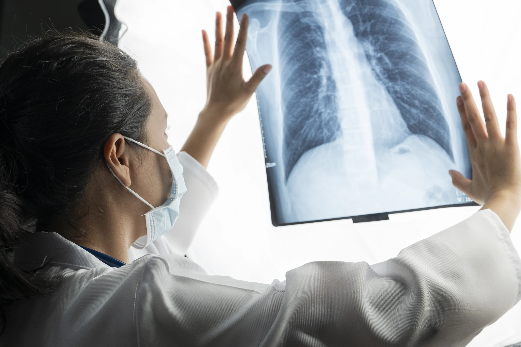 Asthma Lungs X Ray: Key Diagnostic Signs