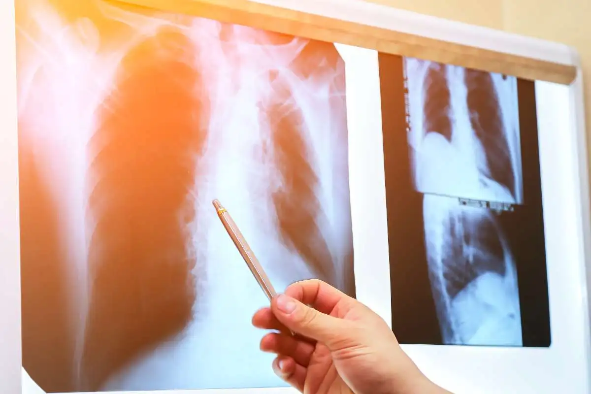 Asthma Attack Chest X Ray: Key Findings