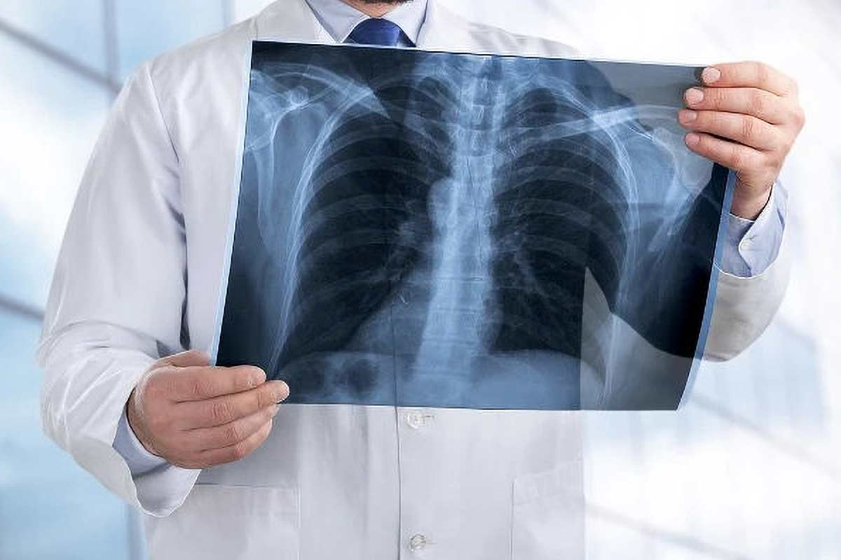 Asthma Attack Chest X Ray: Key Findings