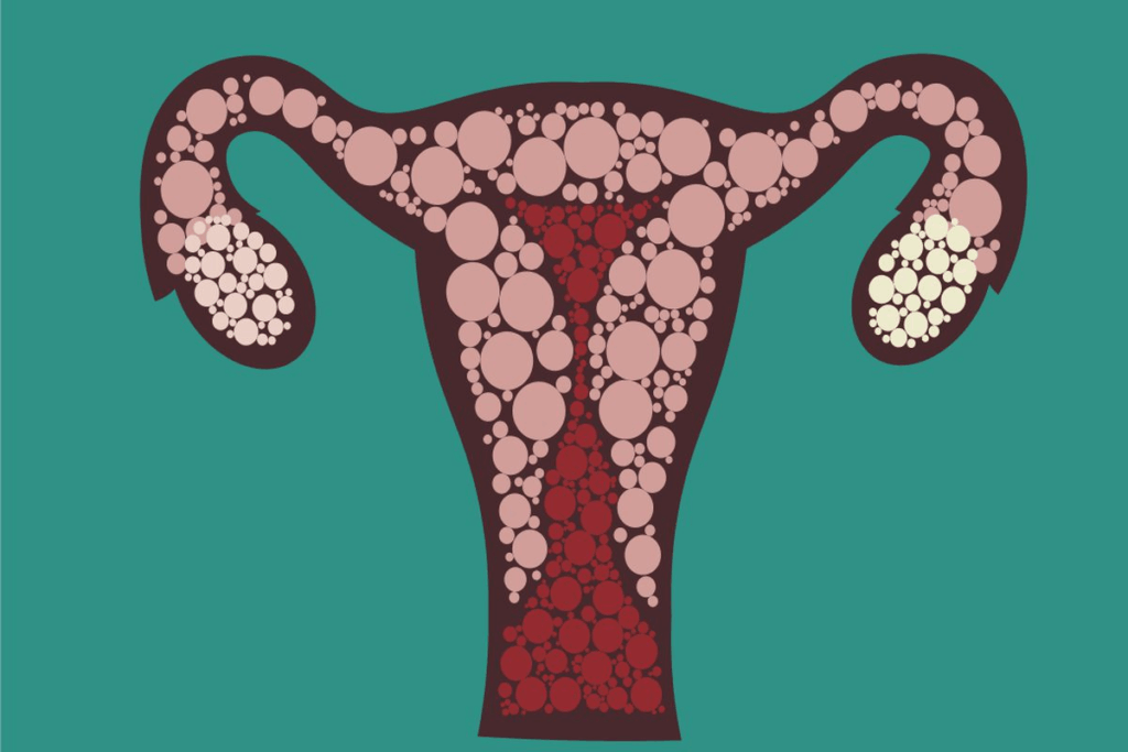 Key Ovary Pain Location: Causes And Relief Options