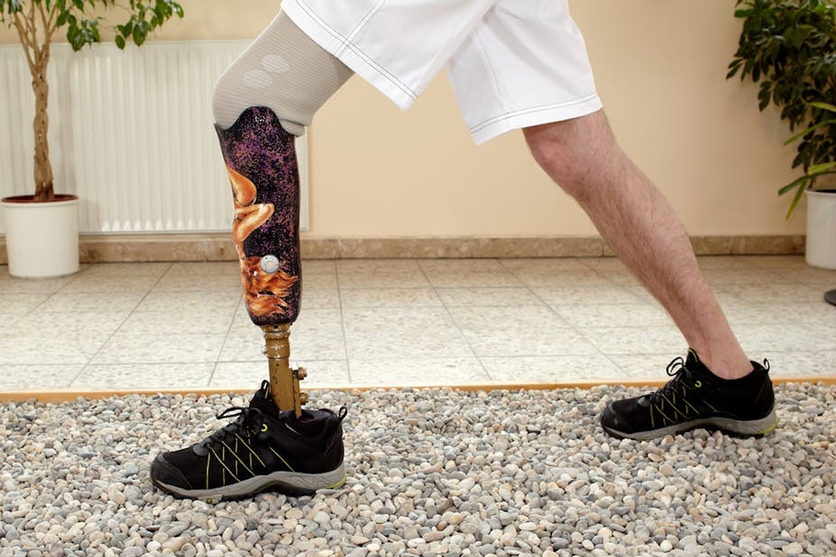 Valuable Choose The Right Implant Leg Prosthetic Options 2 image 1764047950004 LIV Hospital