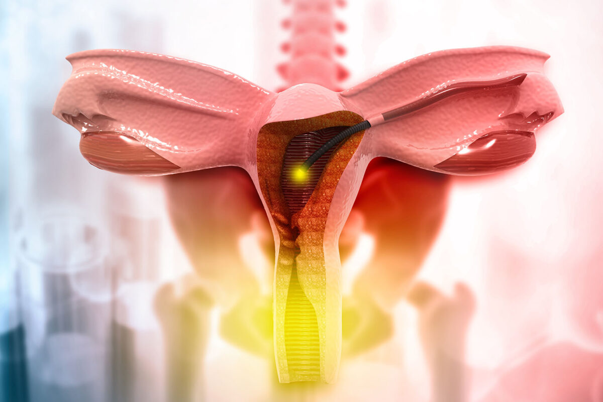 How to Prevent Bladder Prolapse After Hysterectomy