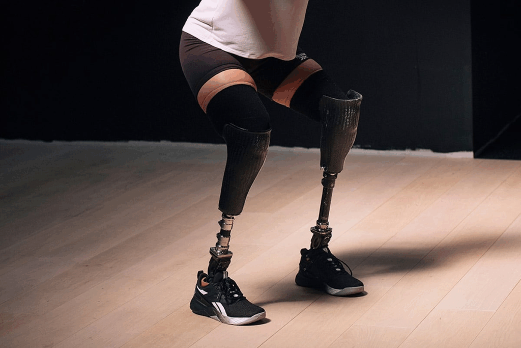 Guide Amputation Statistics: US States With Most Amputees