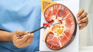 What Causes Stage 3 Kidney Disease and Can It Be Reversed?