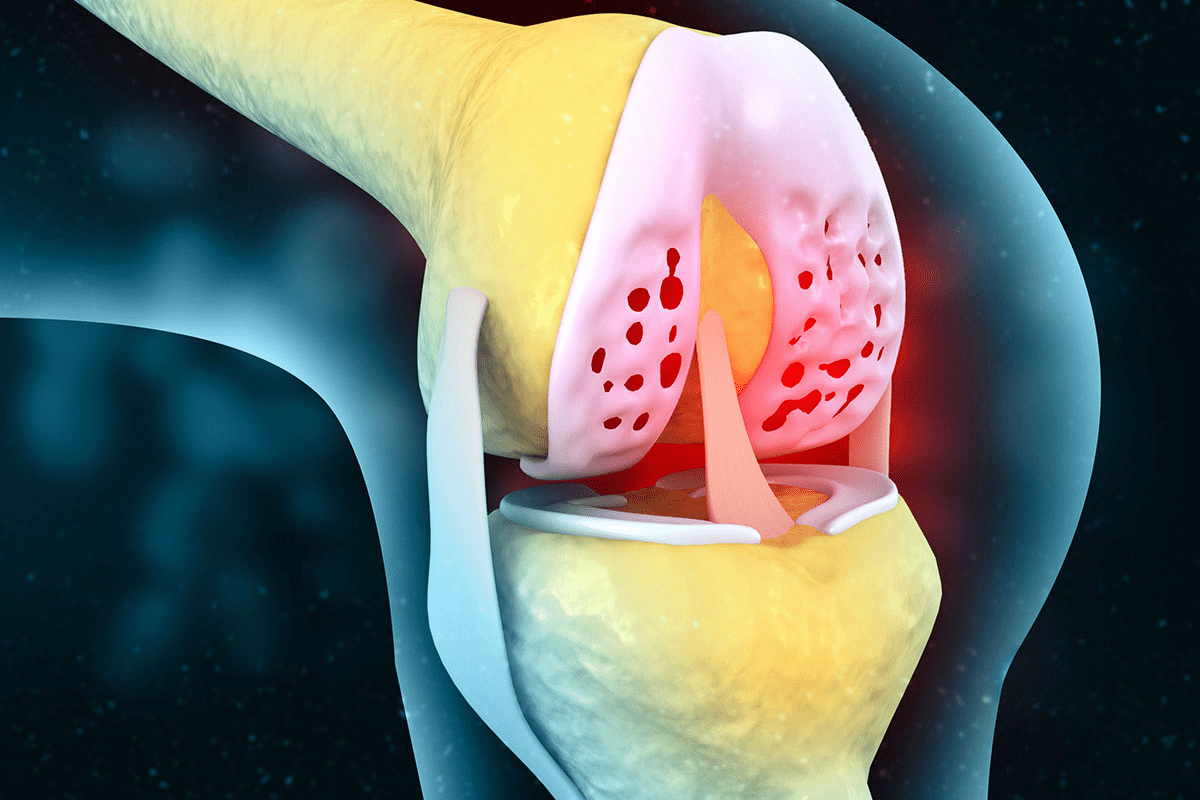 Valuable What Does Right BKA Stand For In Medical Terms?