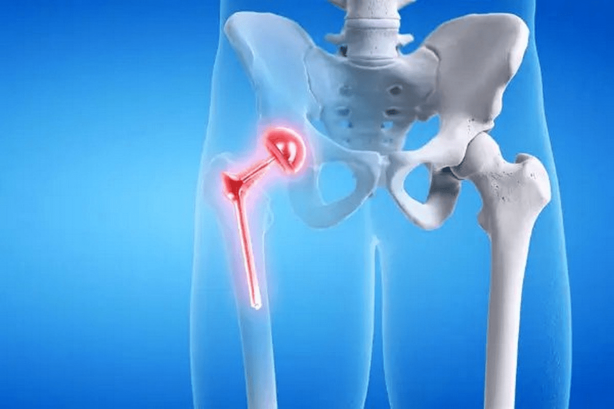 Complete Week 2 Hip Replacement: 5 Key Recovery Milestones 3 Complete Week 2 Hip Replacement: 5 Key Recovery Milestones