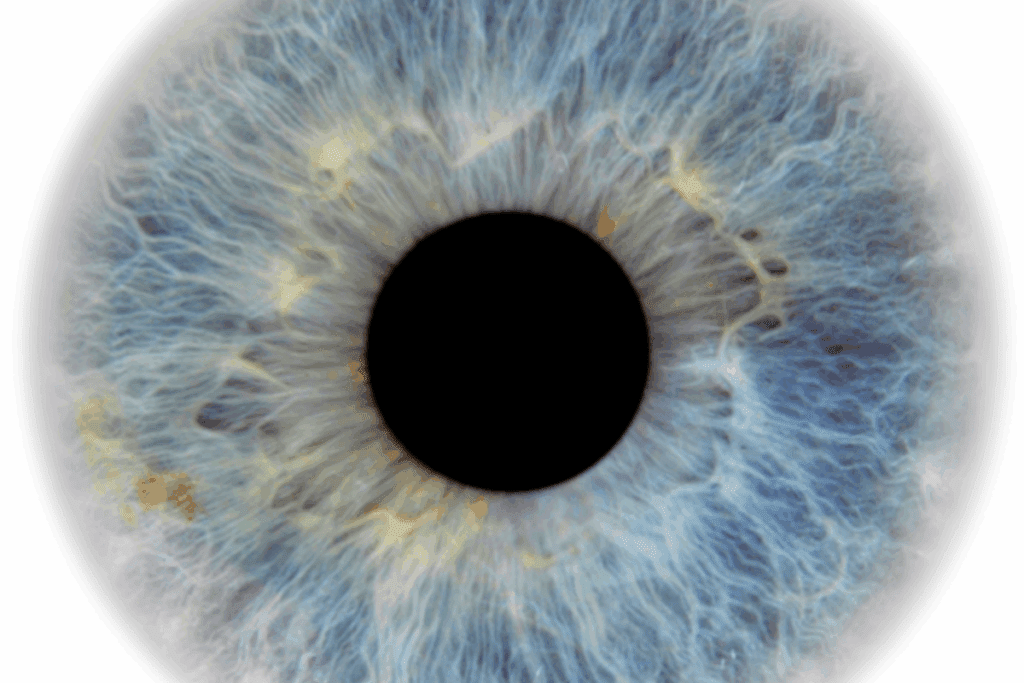 Insightful Macular Degeneration Floaters: Are They Connected?