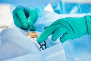 Insightful How To Treat Macular Edema: Eyeball Leaking Fluid