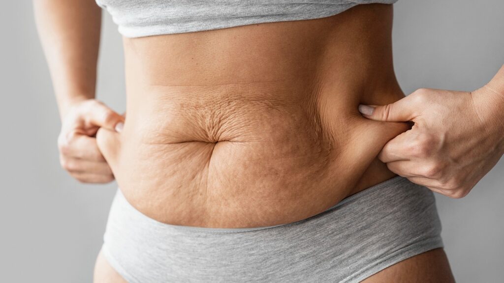 Preventing Loose Skin After Weight Loss Surgery 2 loose skin after weight loss surgery