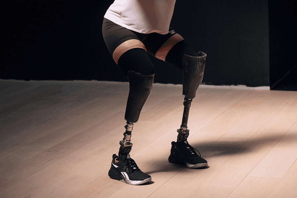 Insightful 7 Types Of Prosthetic Limbs Above Knee Amputee 2 Insightful 7 Types Of Prosthetic Limbs Above Knee Amputee