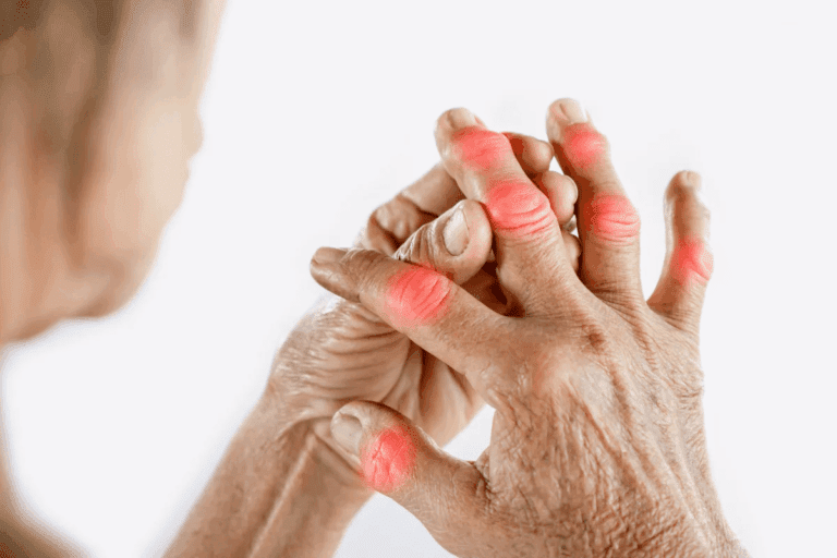 Arthritis In Fingers And Hands