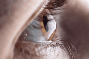 Complete What Causes Leaking Blood Vessels In The Eye?