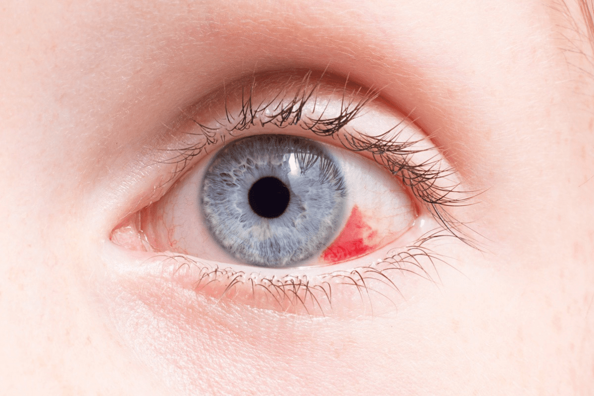 Seeing Blood Vessels in Eye: Why It Happens and When It’s Normal