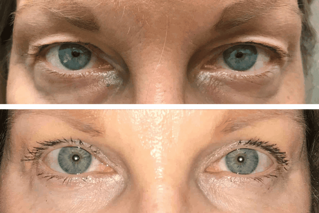 Double eyelid surgery: The Ultimate Asian Eye Guide
