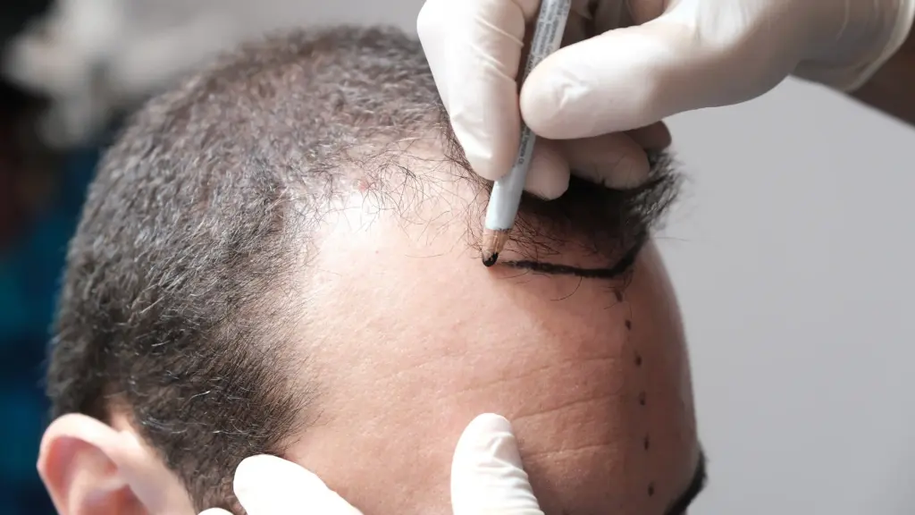 HAIR TRANSPLANT