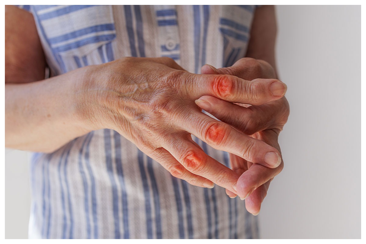 What Can You Do for Arthritis in Your Hands? 2 What Can You Do for Arthritis in Your Hands?