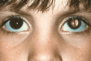 What is moderate diabetic retinopathy? This essential guide explains this key stage, symptoms, and vital treatment.