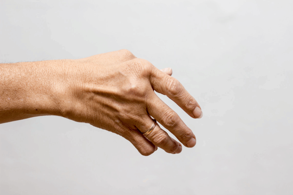 Hand Arthritis Treatment: Relief Strategies