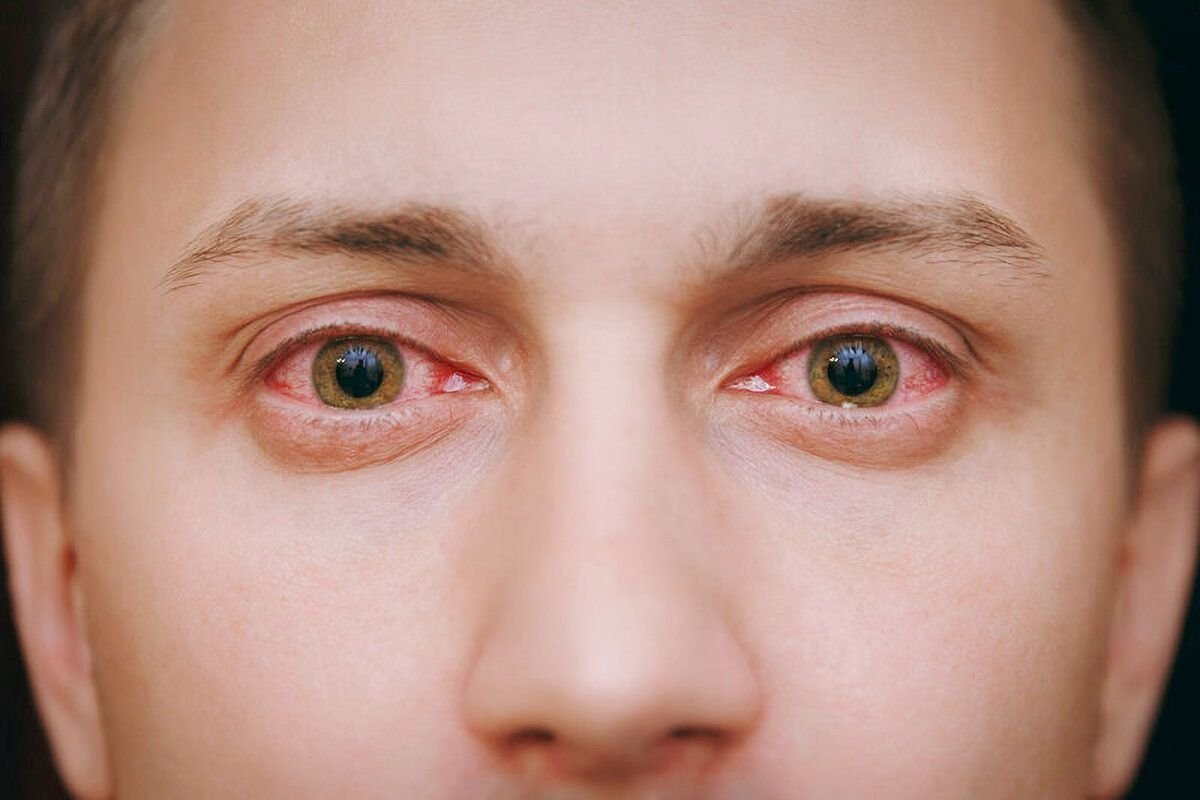 Key Why Do Red Veins Inside Eye Appear In The White? 3 Key Why Do Red Veins Inside Eye Appear In The White?
