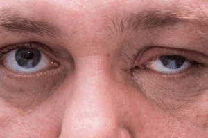Insightful How To Treat Floppy Eyelids Syndrome: Complete Guide