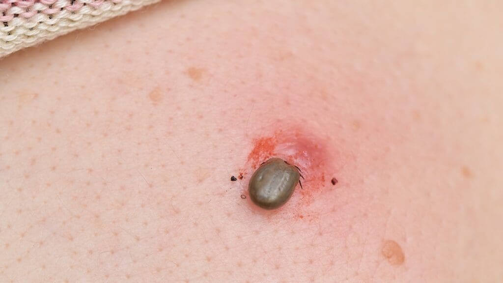 Lyme Disease: Symptoms and Treatment Guide 2 Lyme disease