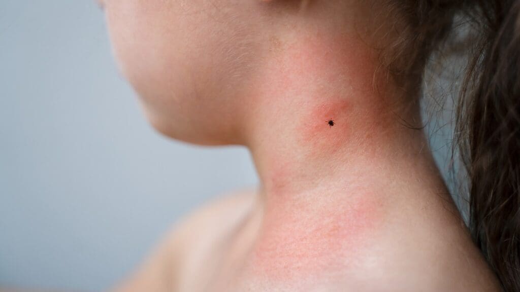 Lyme Disease: Symptoms and Treatment Guide 1 Lyme disease