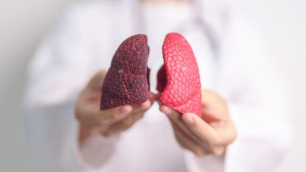 Pneumonia: Symptoms and Treatment Guide 2 pneumonia