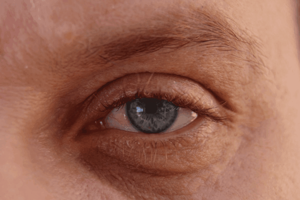 Keratitis vs Uveitis: Critical Red Eye Differences 1 Keratitis vs Uveitis: Critical Red Eye Differences