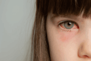 Foggy Vision After Vitrectomy: Why It's Happening