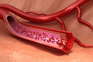 Blood Vessel Occlusion After Filler: 5 Warning Signs