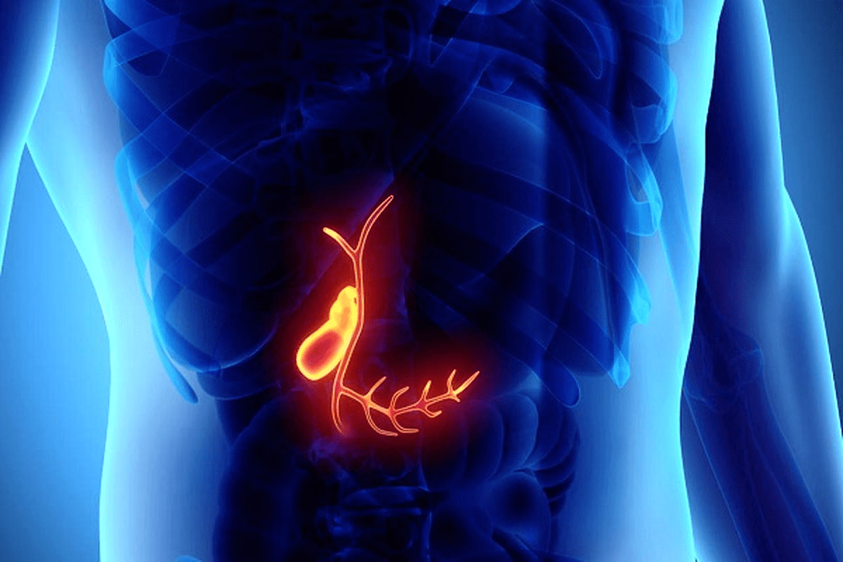 Dumping Syndrome After Gallbladder Removal Guide