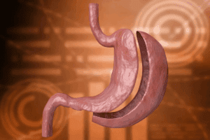 Gastric Bypass Changes: Amazing Body & Life Guide