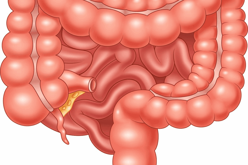 Colectomy Hospital Stay Duration: Expert Facts 1 Colectomy Hospital Stay Duration: Expert Facts