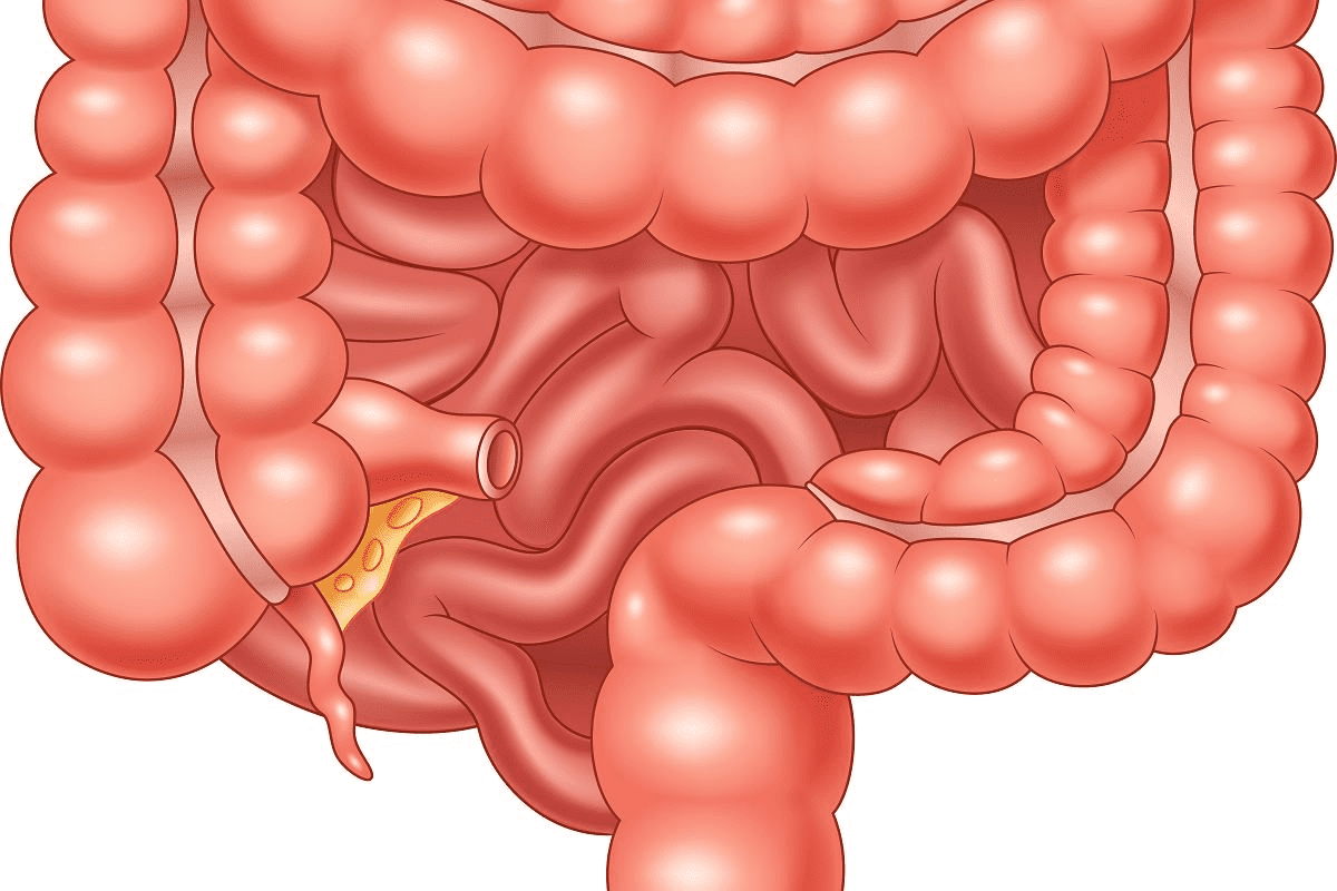 Colectomy Hospital Stay Duration: Expert Facts