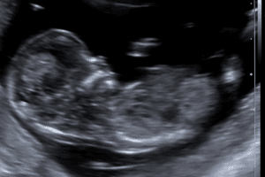 Gender 20 Week Ultrasound 4D: Amazing Views