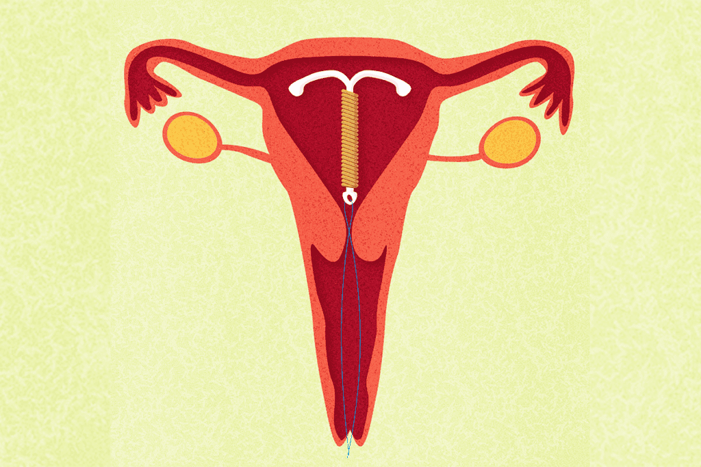 Earliest Signs of Pregnancy with PCOS: 7 Surprising