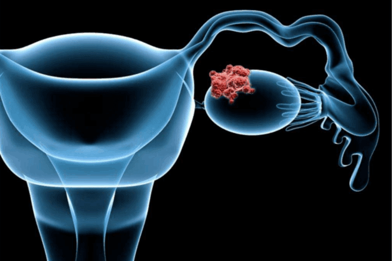 Stage 3 Endometrial Cancer Life Expectancy