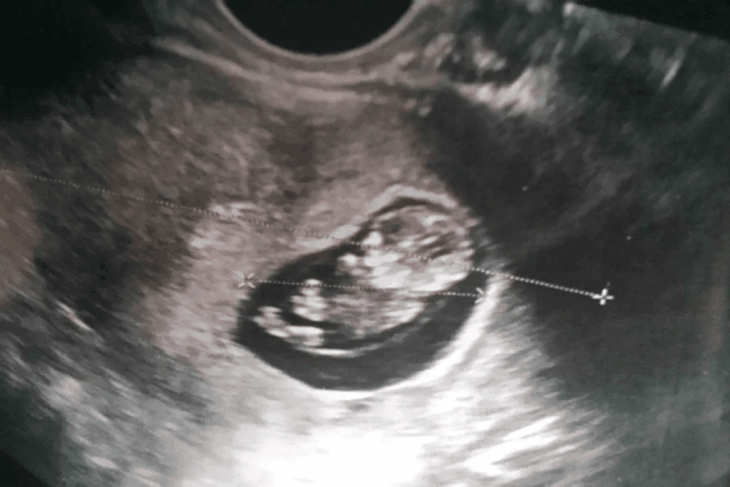 Fetal Abdominal Circumference: Critical Guide