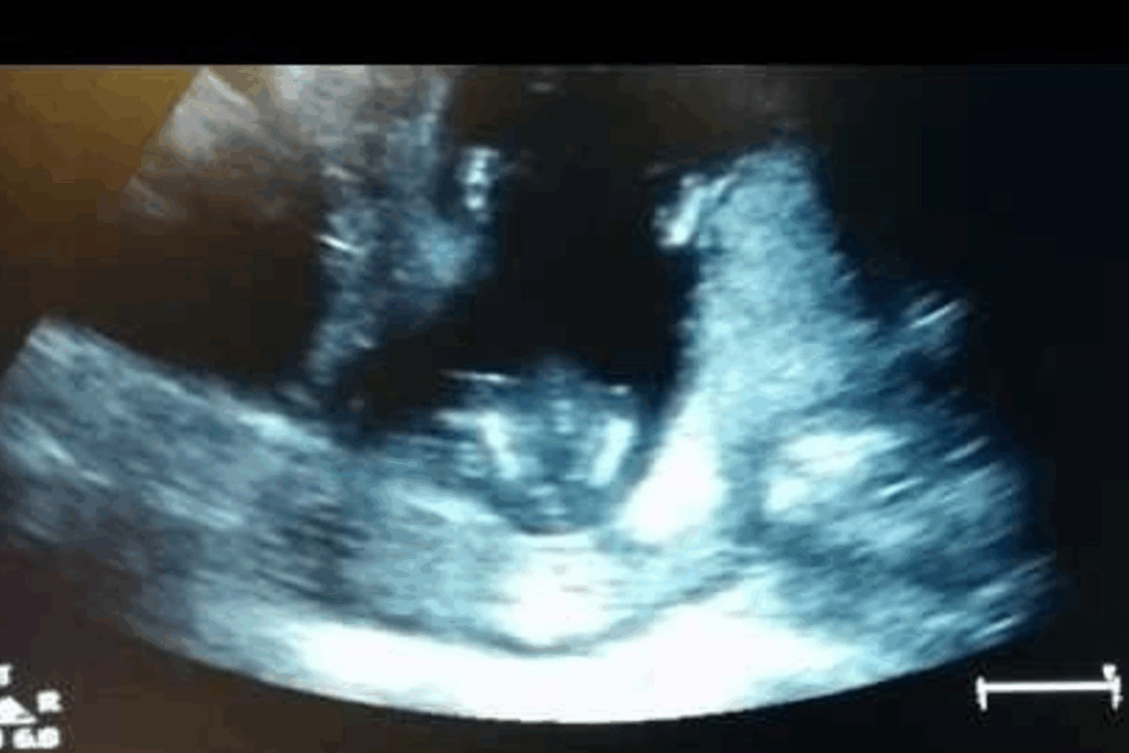 Profound What Does A 9 Weeks Pregnant Sonogram Show?